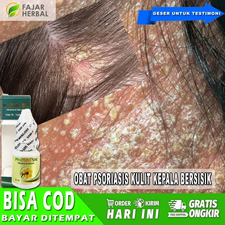 Obat Psoriasis Kulit Kepala Bersisik Obat Luka Kepala Obat Iritasi Kulit Kepala Obat Benjolan Kepala Obat Benjolan Di Kepala Propolis Sm Lazada Indonesia