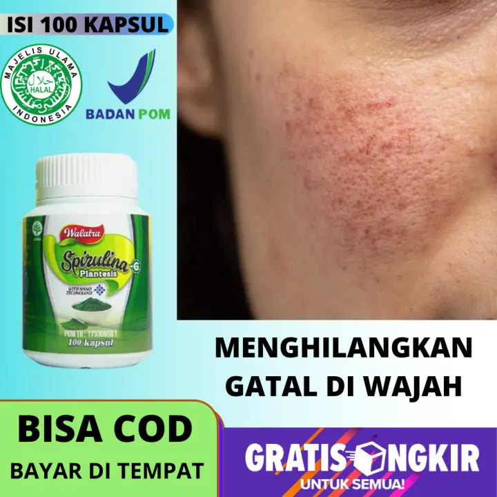 Obat Kulit Wajah Gatal Masker Untuk Menghilangkan Rasa Gatal Di Muka Anak Untuk Kulit Muka Gatal Obat Kulit Wajah Gatal Masker Untuk Menghilangkan Rasa Gatal Di Muka Anak Untuk Kulit Muka Gatal