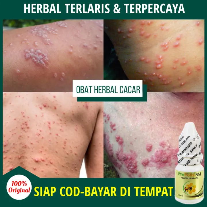 Obat Cacar Air Herbal Obat Cacar Api Dewasa Obat Cacar Bernanah Obat Bekas Cacar Ular Obat