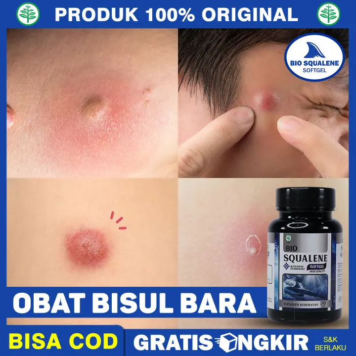 Obat Bisul Bara Obat Bisul Tanpa Mata Obat Alami Bisul Besar Obat Jerawat Bisul Obat Bisul