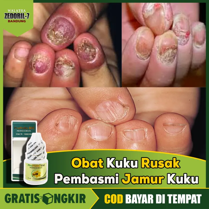 Propolis Sm Original Obat Kuku Rusak Pembasmi Jamur Kuku Kuku Kuning Mengkerut Kuku Mengelupas Kuku Rapuh