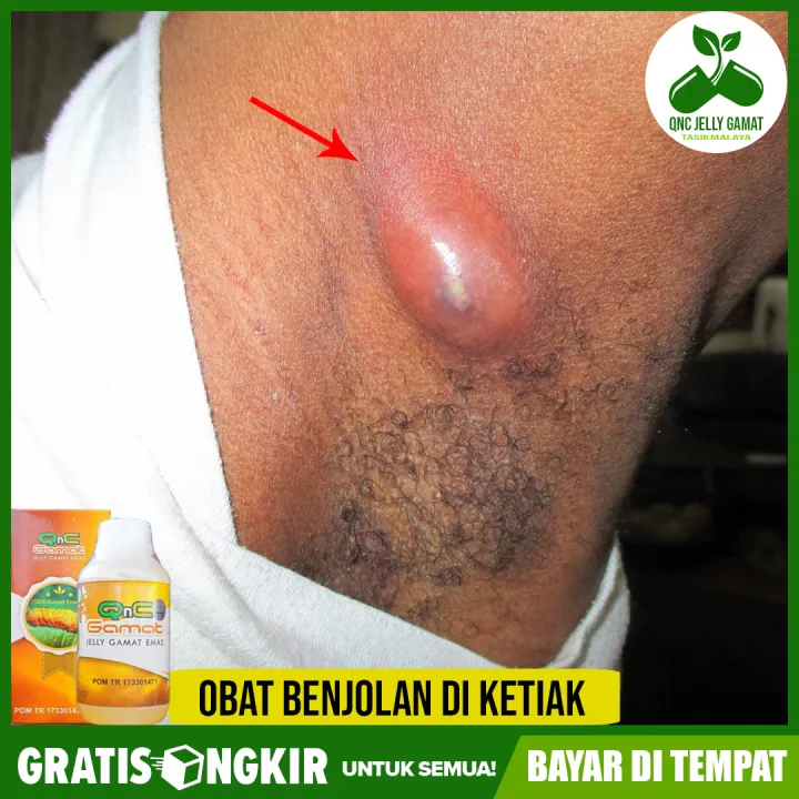 Obat Benjolan Di Ketiak Penghilang Benjolan Di Bawah Ketiak Ketek Herbal Qnc Jelly Gamat Lazada Indonesia