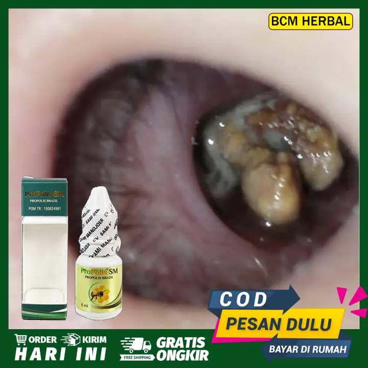 Obat Hidung Bau Busuk Ingus Kuning Kehijauan Sinusitis Akut Radang Rongga Sinus Konka Bengkak Hidung Tersumbat Anosmia Pilek Flu Kronis Gangguan Indra Penciuman Propolis Sm Brazil 6ml Lazada Indonesia