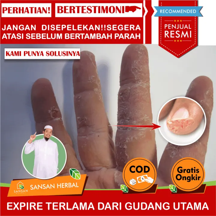 Obat Jari Tangan Pecah Pecah Obat Jari Tangan Kering Dan Pecah Salep Jari Tangan Pecah Salep