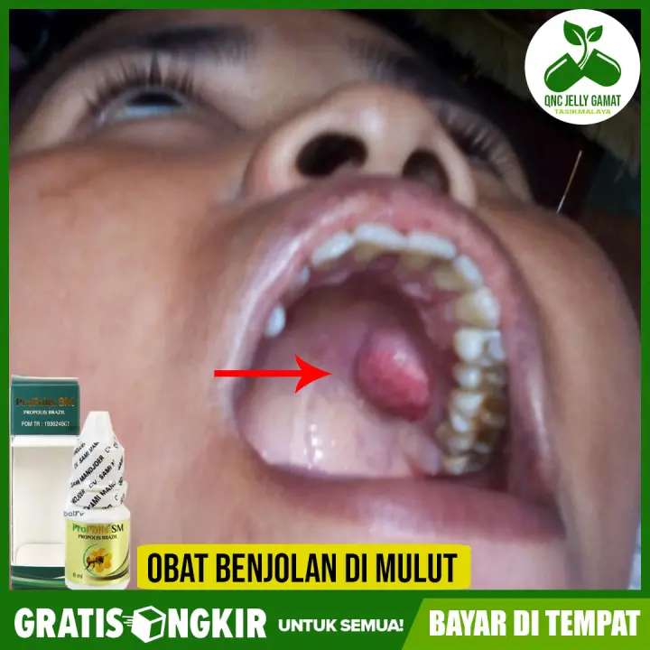 Obat Untuk Benjolan Keras Di Langit Mulut Propolis Sm Lazada Indonesia