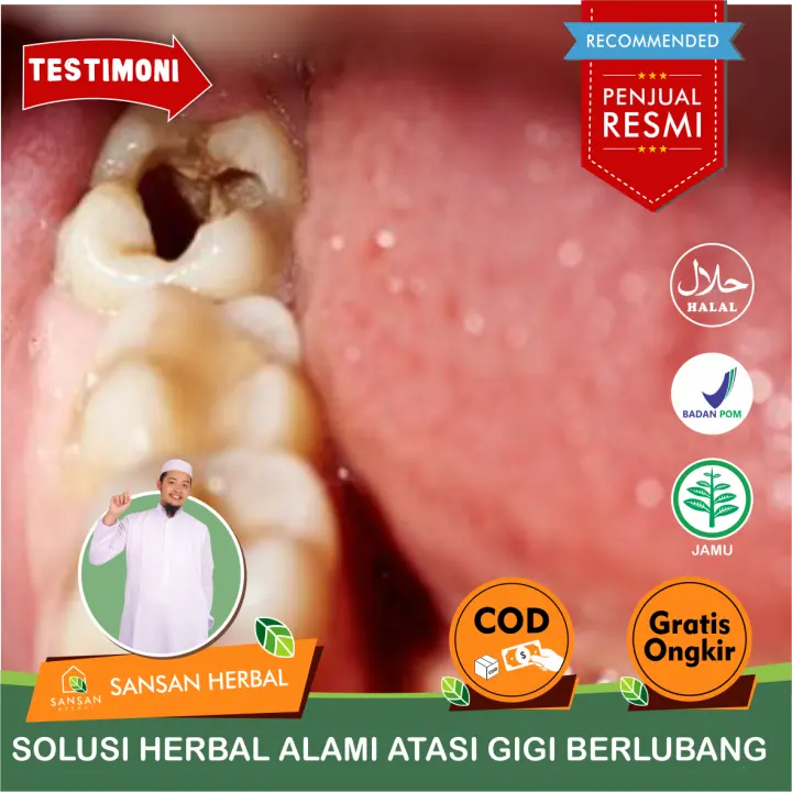 Obat Sakit Gigi Berlubang Anak Propolis Sm Tetes Sakit Gigi Gusi Bengkak Gigi Geraham Bengkak Gigi Linu Sensitif Gusi Sariawan Nyeri Gusi Gusi Berdarah Radang Gusi Gigi Keropos Walatra Propolis Sm