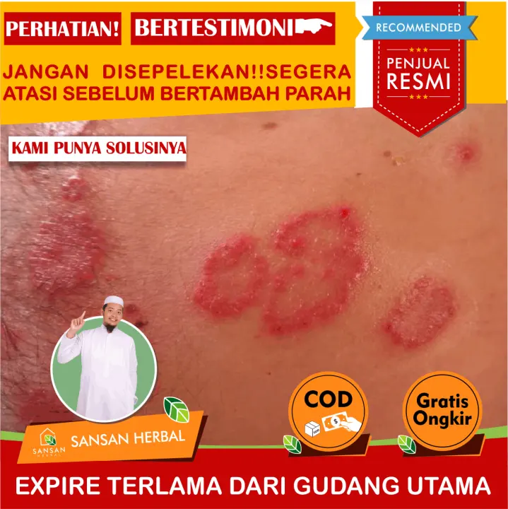 Obat Ruam Bintik Merah Pada Kulit