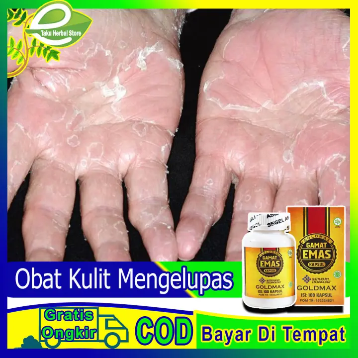 Obat Kulit Mengelupas Obat Kulit Wajah Mengelupas Obat Kulit Kaki Tangan Mengelupas Obat Jamur Kulit Obat Penyakit Kulit Obat Kulit Mengelupas Menahun Obat Kelainan Kulit Obat Kulit Mengelupas Anak Dewasa Obat Khusus Kulit Mengelupas