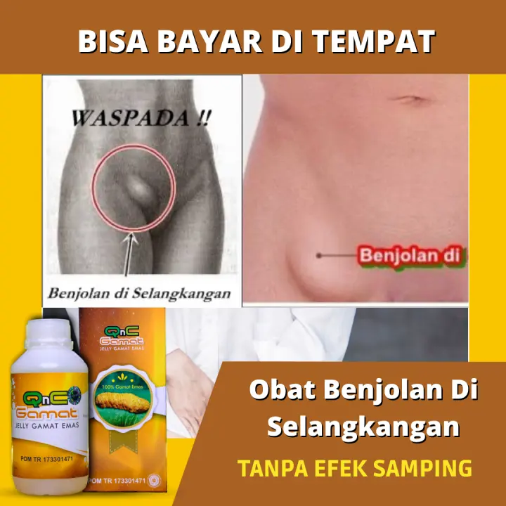 Obat Benjolan Di Selangkangan Herbal Benjolan Di Selangkangan Kanan Benjolan Di Selangkangan Kiri Tumor Di Selangkangan