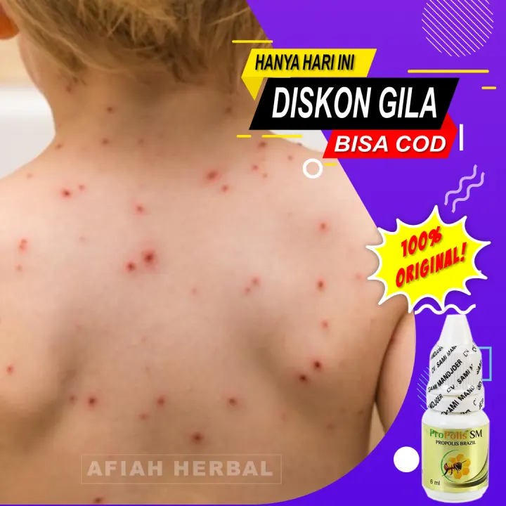 Obat Cacar Air Dewasa Obat Cacar Air Untuk Anak Obat Cacar Air Obat Cacar Api Anak