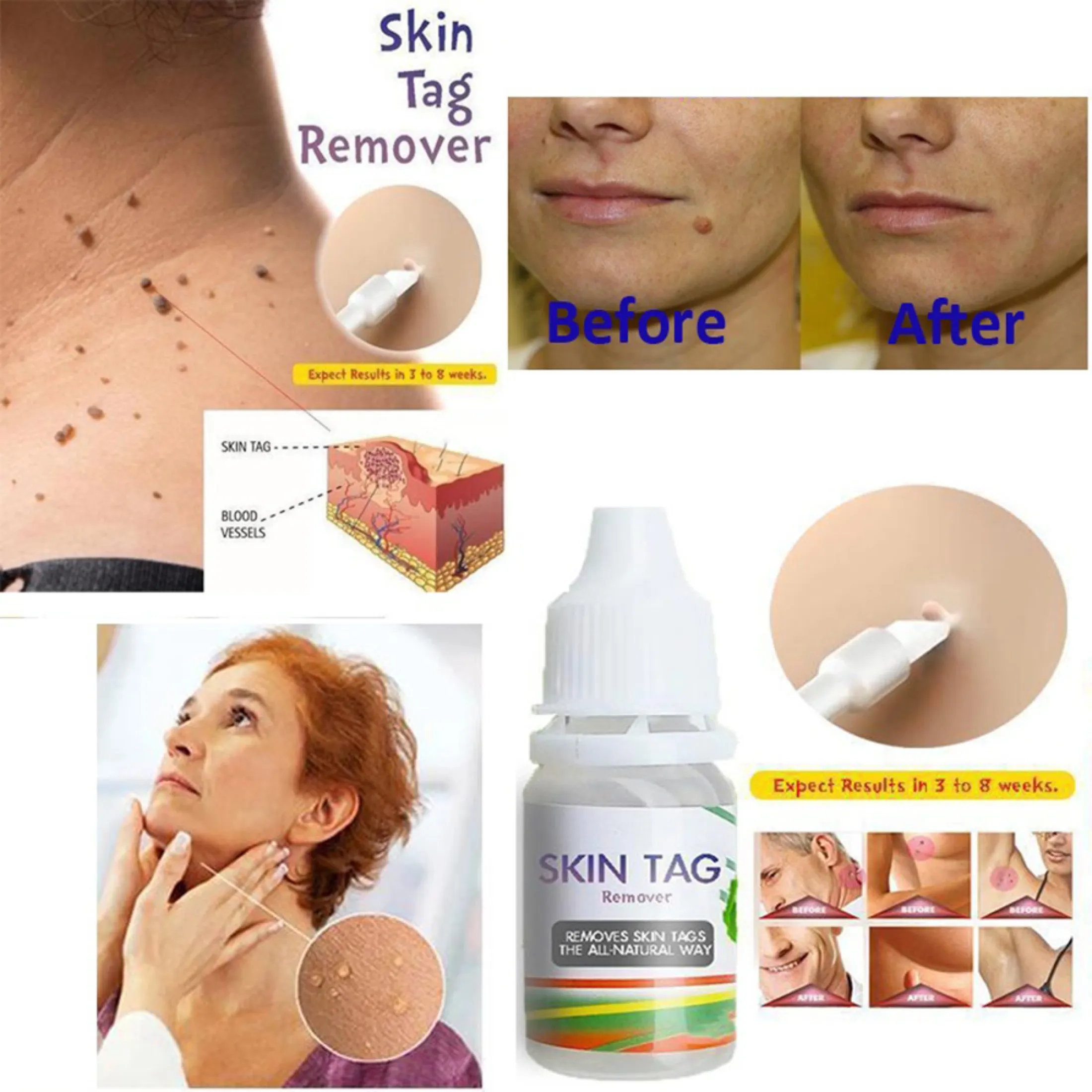 10ml Skin Tag Remover Chinese Medicine Treatment Skin Warts Removal Plantar Warts Skin Care Medical Ointment Warts Remover And Mole Remover Best Selling Warts Remover Lazada Singapore