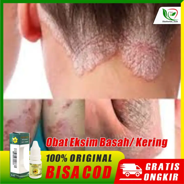 Obat Eksim Herbal Oles Eksim Basah Dan Kering Obat Eksim Gatal Untuk Dewasa Hingga Anak Herbal