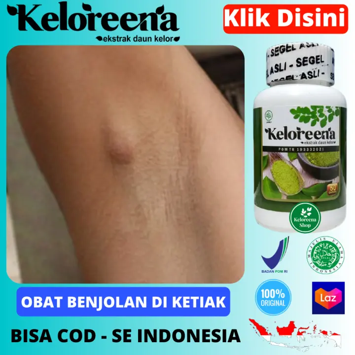 Obat Benjolan Di Ketiak Penghilang Benjolan Ketiak Sebelah Kiri Atau Kanan Ketek Sakit Dan Pegal Akibat Kelenjar Getah Bening Tumor Jinak Pada Ketiak Pengecil Benjolan Lunak Keras Bernanah Di Lipatan Ketiak