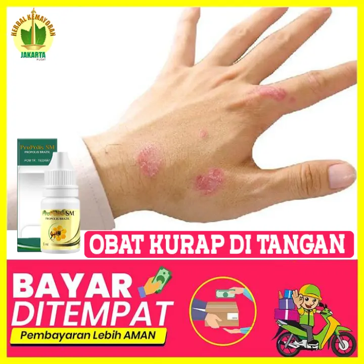 Gejala Awal Psoriasis Gejala Penyebab Dan Pengobatan Psoriasis