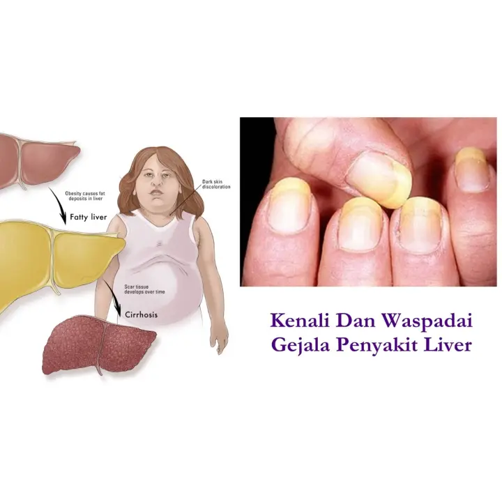 Obat Sirosis Hati Hepatitis Hepatisis A B C D Sirosis Liver Penambah Nafsu Makan Penyakit Kuning Susah Tidur Naturindo 100 Original Lazada Indonesia