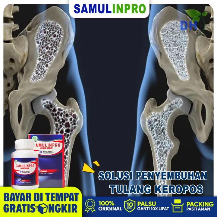 Obat Tulang Keropos Osteoporosis Tulang Retak Nyeri Telapak Tangan Nyeri Sendi Dan Rematik Sakit Pinggang Nyeri