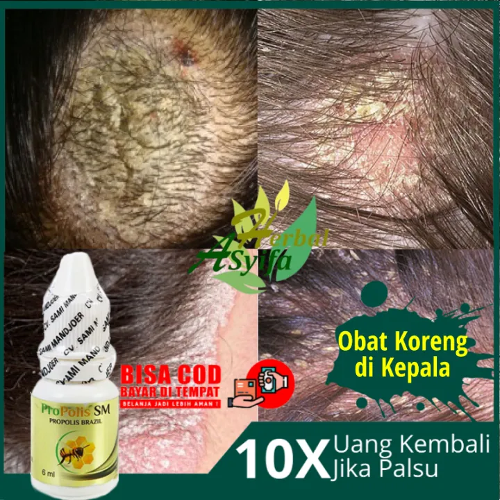 Obat Koreng Herbal Obat Koreng Di Kepala Obat Luka Koreng Di Kulit Kepala Obat Oles Koreng
