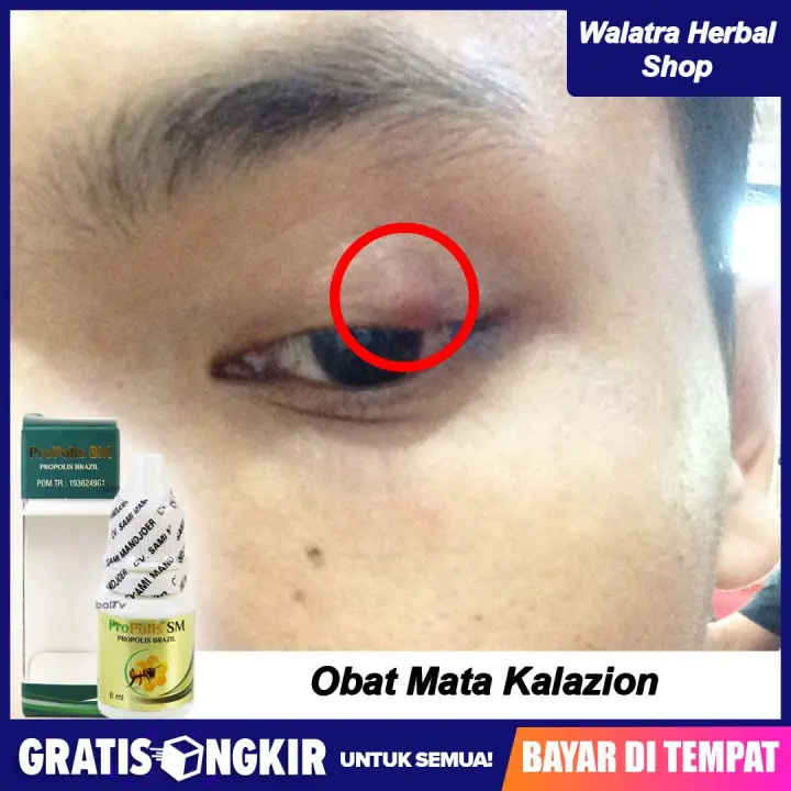 Obat Mata Kalazion Benjolan Di Kelopak Mata Mata Bintitan Mata Bengkak Propolis Sm Lazada Indonesia