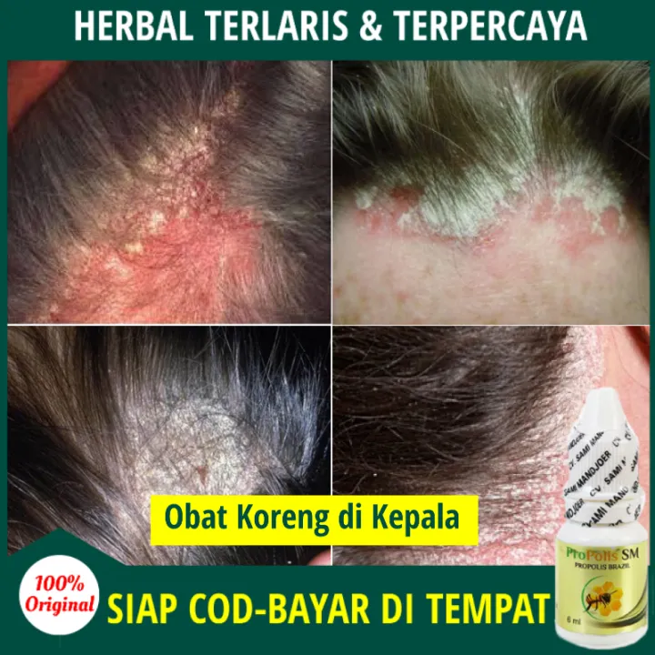 Obat Koreng Di Kepala Penghilang Koreng Bernanah Obat Oles Bekas Luka Koreng Budug Di Kulit Kepala Borok Psoriasis Ketombe Basah Kering Ketombe Parah Obat Untuk Luka Koreng Berair Dan Gatal Salep Untuk