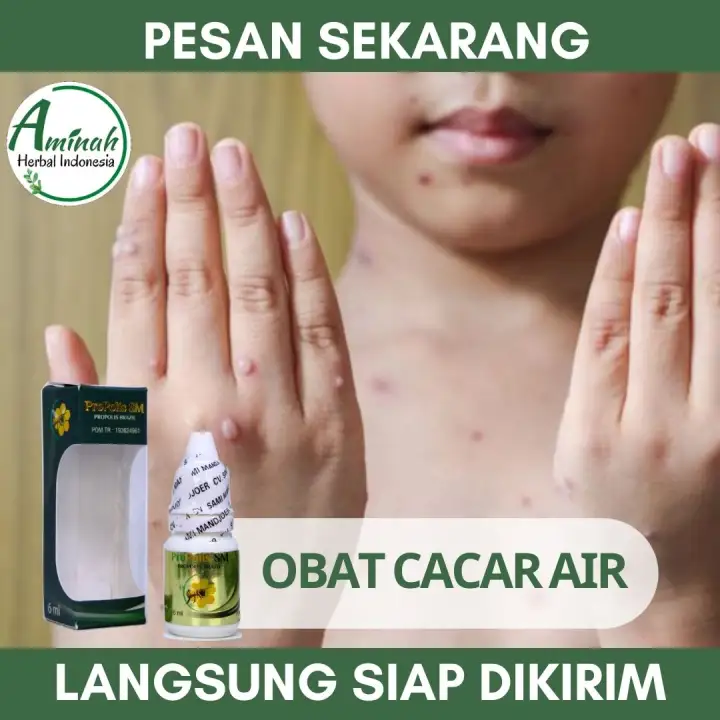 Obat Cacar Air Tradisional Obat Cacar Air Obat Gatal Cacar Air Obat Cacar Air Bernanah Obat