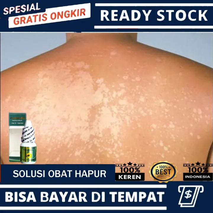 Dr Zubaidi Ahmad Penyakit Kurap Kurap Atau Tinea Corporis Adalah Sejenis Penyakit Kulit Yang Disebabkan Oleh Jangkitan Sejenis Kulat Fungi Yang Dipanggil Dermatophyte Tiga Jenis Dermatophyte Yang Dikenal Pasti