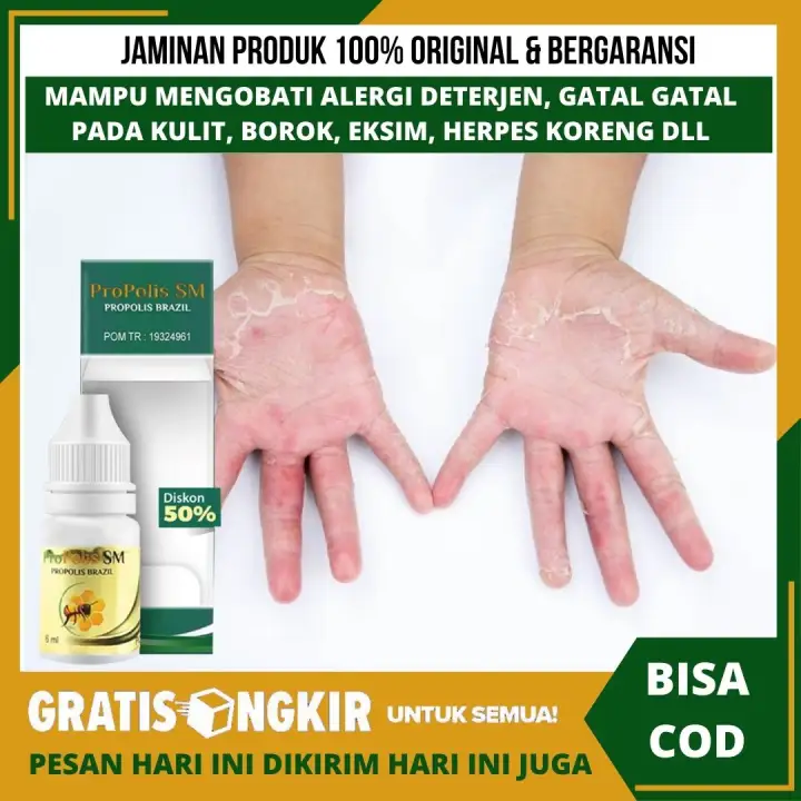 Obat Alergi Deterjen Alergi Pada Kulit Elergi Sabun Detergen Kulit Dan Kaki Tangan Gatel Kulit Kering