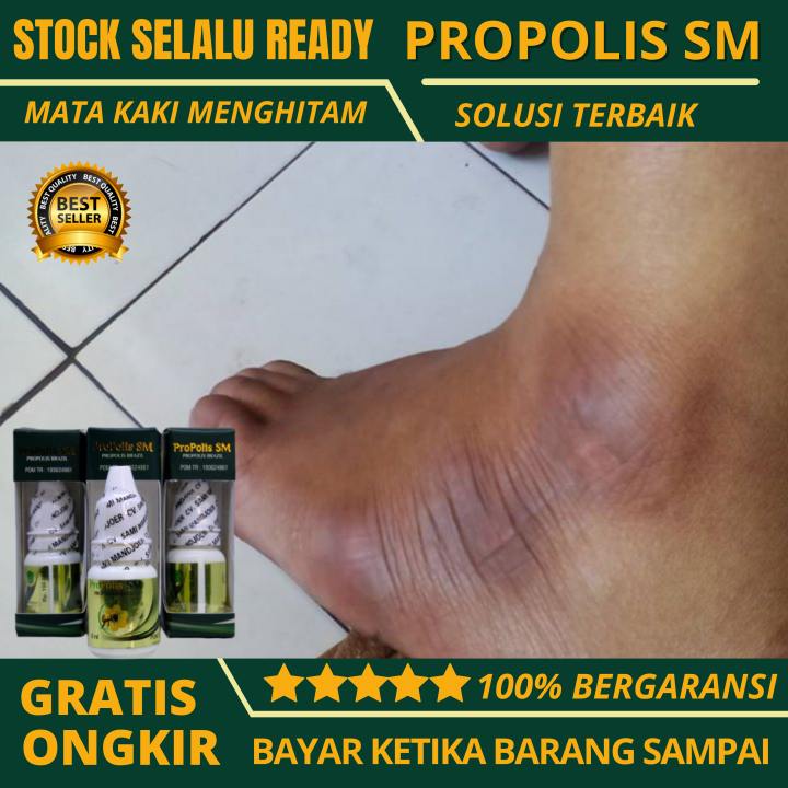 Obat Mata Kaki Hitam Dan Kasar Menghitam Kering Sel Kulit Kaki Mati Salep Pemutih Mata Kaki Hitam Eksim Kering Propolis Sm Aman Untuk Anak Dan Dewasa 100 Asli Lazada Indonesia
