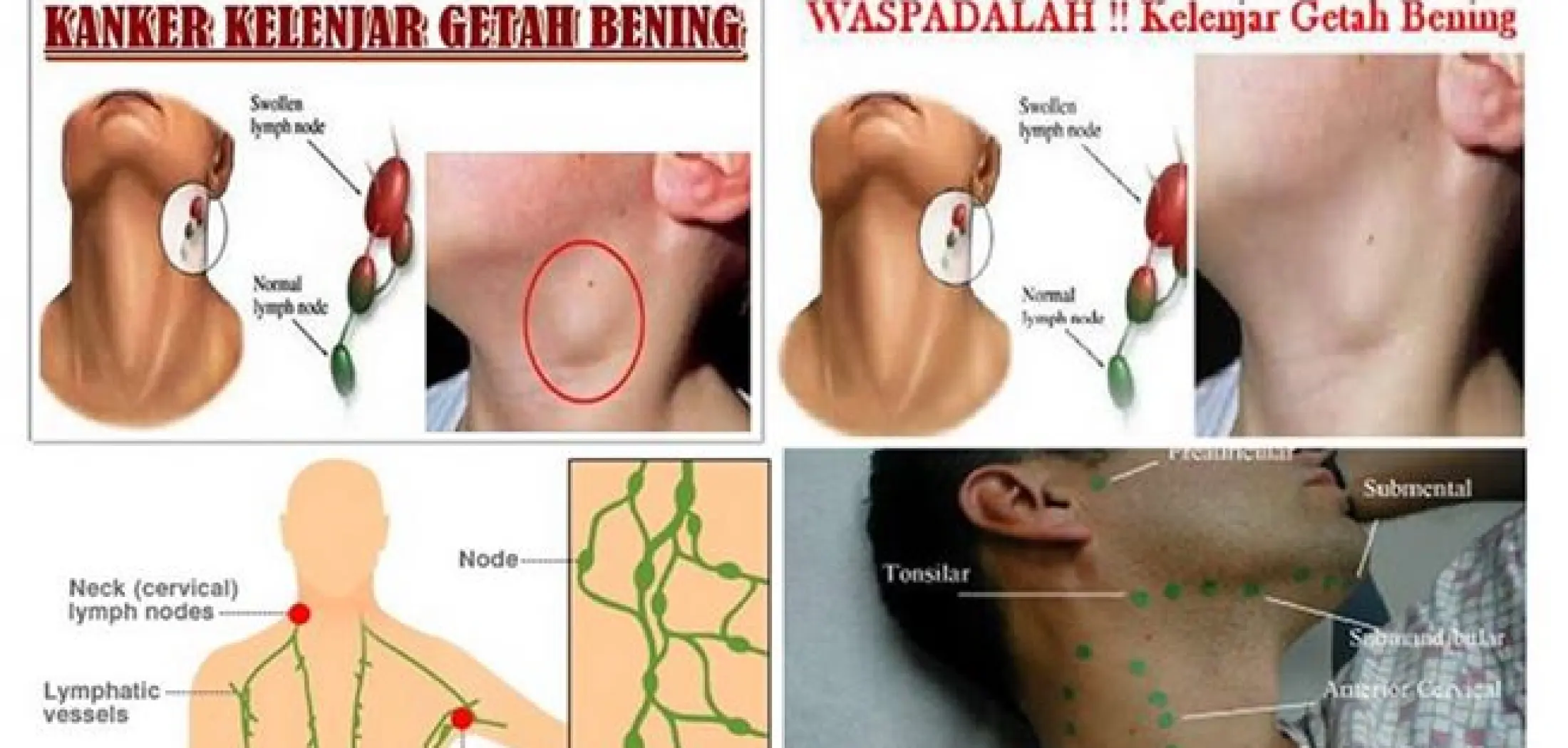 Obat Kelenjar Getah Bening Leher Benjolan Leher Leher Bengkak Obat Kelenjar Getah Bening Yang Bengkak Obat Pembengkakan Kelenjar Getah Bening Obat Bengkak Di Leher Obat Benjolan Di Leher Obat Limfoma