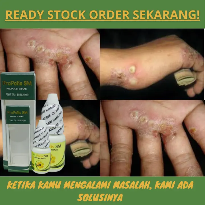 Obat Cenang Bernanah Borok Budug Cenang Di Tangan Cenang Di Telapak Tangan Benjolan Nanah Di Jari