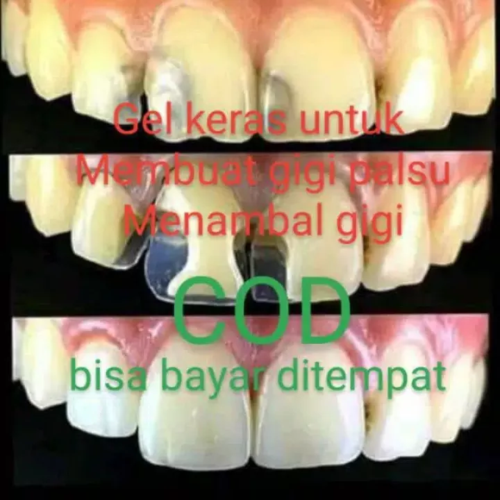Gigi depan patah karena keropos