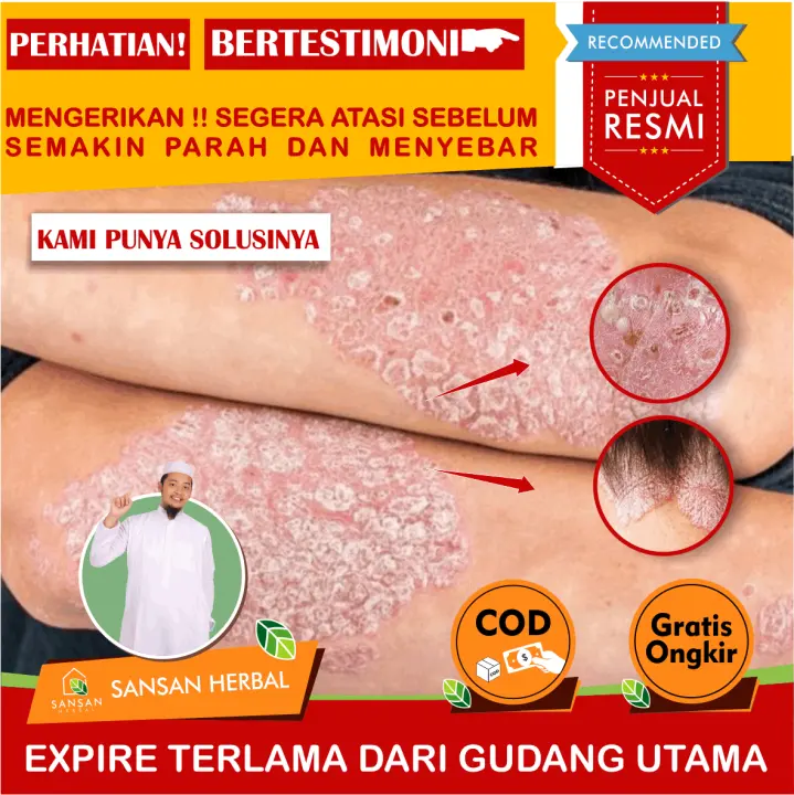 Sabun Mandi Psoriasis Sabun Mandi Untuk Psoriasis Sabun Untuk Psoriasis Sabun Untuk Kulit Kering Bersisik Sabun Untuk Menghilangkan Kulit Bersisik Sabun Penghilang Kulit Bersisik Kulit Kering Bersisik Dan Gatal Dengan Sabun Natural