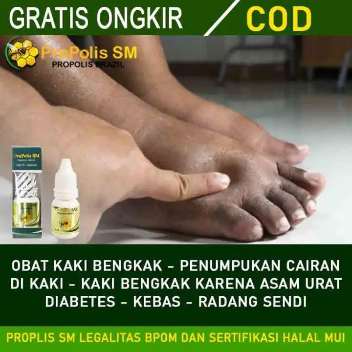 Obat Kaki Bengkak Sebelah Penumpukan Cairan Di Kaki Obat Kaki Bengkak Karena Asam Urat Kaki Bengkak
