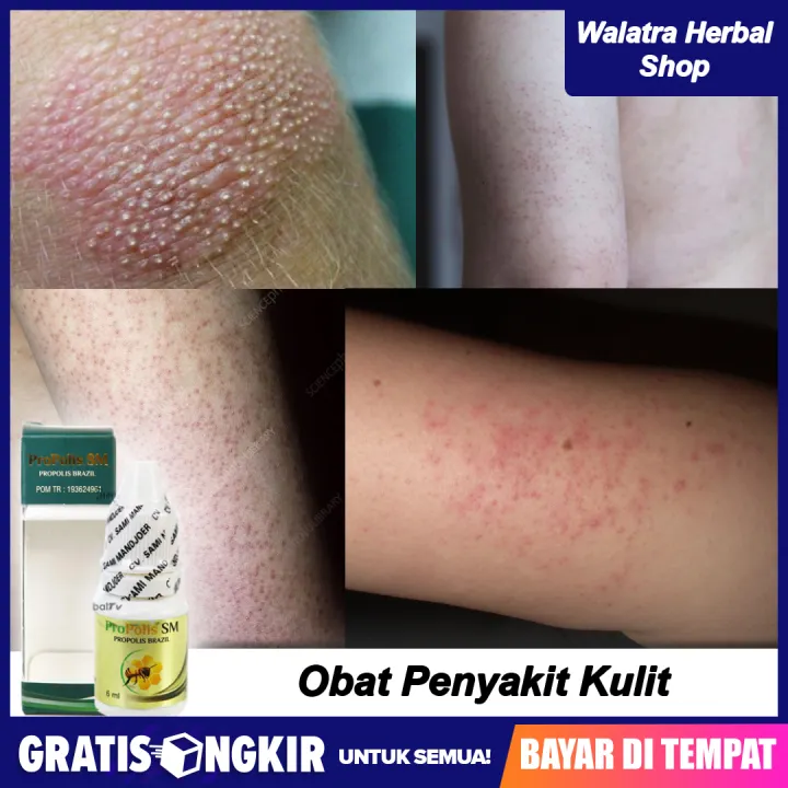 Obat Penyakit Kulit Seperti Kulit Ayam Gatal Keratosis Pilaris Bentol Kecil Berwarna Merah Kulit Terasa Kering Dan Kasar Propolis Sm Lazada Indonesia