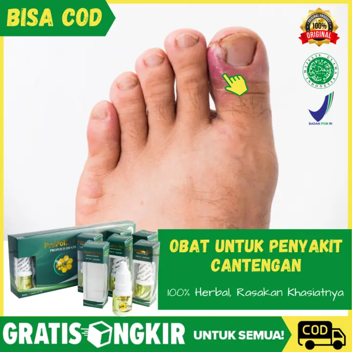 Obat Cantengan Obat Cantengan Jempol Kaki Obat Herbal Cantengan Kuku Kaki Dan Tangan Obat Jempol Bengkak Obat Bisul Di Jari Kuku Obat Jamur Di Kaki Cantengan Di Ibu Jari Bengkak