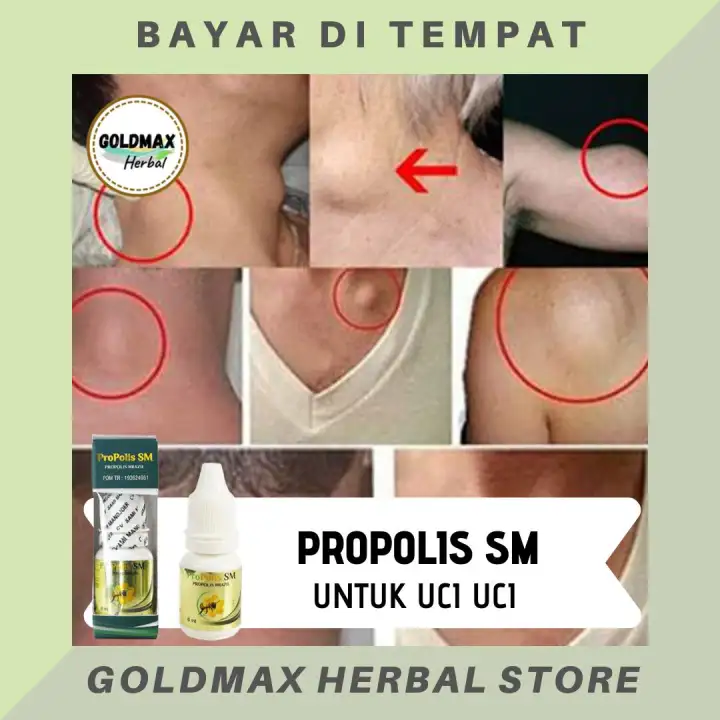 Obat Uci Uci Benjolan Di Leher Skin Tag Pertumbuhan Jaringan Kulit Berlebihan Lipoma Pertumbuhan Berlebihan Sel<script async src=