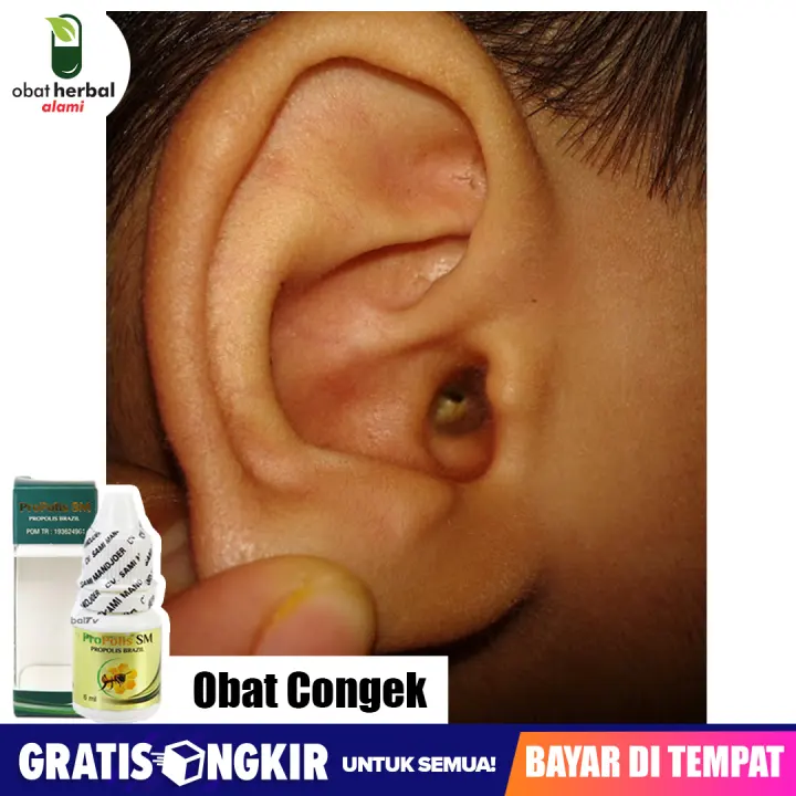 Obat Congek Menahun Telinga Berair Bernanah Berdengung Telinga Gatal Berair Bau Telinga Infeksi Propolis Sm Lazada Indonesia