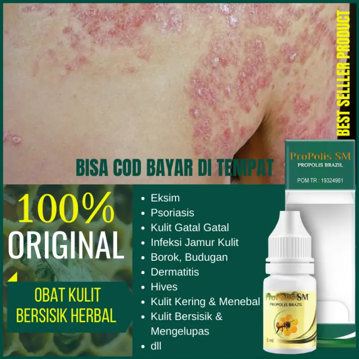 Obat Kulit Bersisik Obat Infeksi Jamur Kulit Obat Kulit Gatal Kulit Eksim Kulit Psoriasis Budug Hives