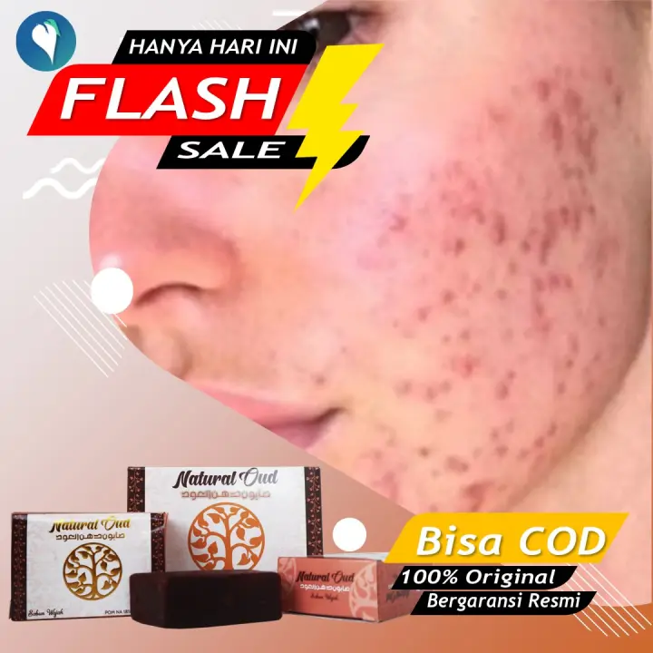 Sabun Jerawat Beruntusan Parah 100 Asli Anti Acne Dan Bekas Jerawat Sabun Muka Menghilangkan Flek Hitam Berminyak Tanda Tanda Penuaan Komedo Bandel Jerawat Punggung Wajah Glowing Pemutih Pria Wanita Natural Oud