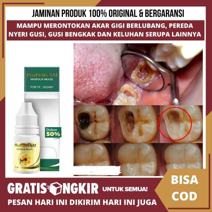 Obat Agar Gigi Berlubang Cepat Rontok Cara Alami Agar Gigi Yang Sudah Keropos Cepat Lepas Selain Cabut Gigi Menghancurkan Gigi Perontok Gigi Sampai Ke Akar Gigi Cepat Hancur Gigi Retak Atau Patah