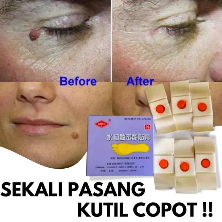 Hansaplas Buat Ikan Hansaplas Obat Kutil Koyok Mata Ikan Lotion Penghilang Ta Hi Lalat Menghilangkan Kutil Menghilangkan Korengan Saat Hamil Formu Clear Buat Papiloma Plester Kutil Lazada Indonesia