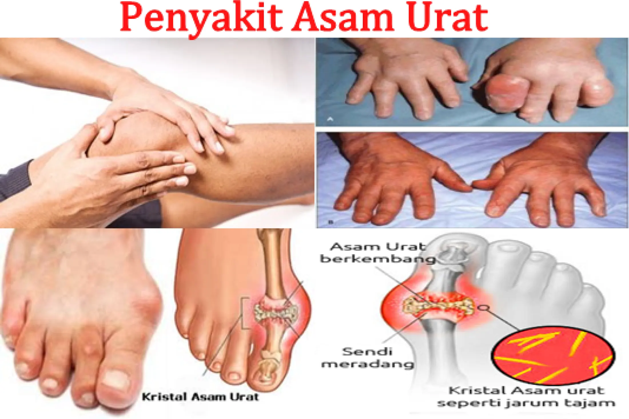 Obat Asam Urat Tinggi Sendi Terasa Nyeri Panas Dan Kaku Ciri Ciri Asam Urat Di Kaki Tangan Sendi Terasa Nyeri Panas Dan Kaku Kaki Bengkak Dan Merah Kesemutan Rasa Sakit Dan Nyeri Kaku Tangan Dan